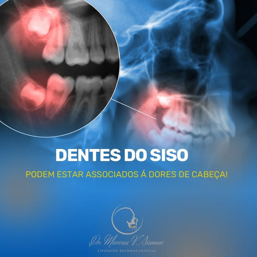 Dentes do siso-Podem causar dor de cabeça