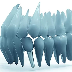 Implantes dentários -Recupere o seu sorriso e auto estima 